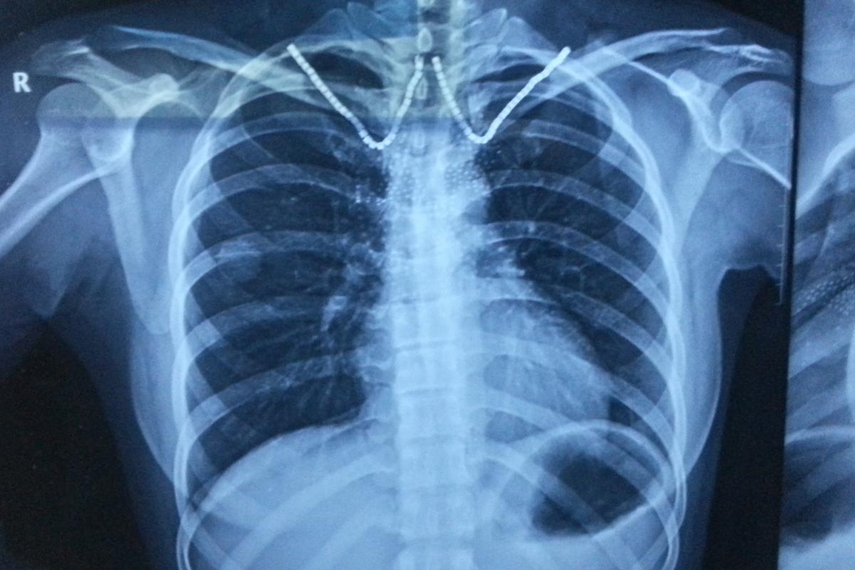 间质性肺炎听诊velcro音试听-亚博体育入口